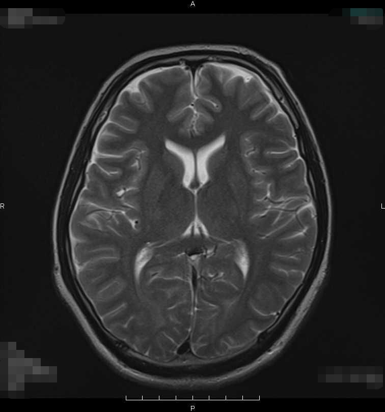 MRI_脳