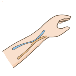 dialysis-internal-shunt